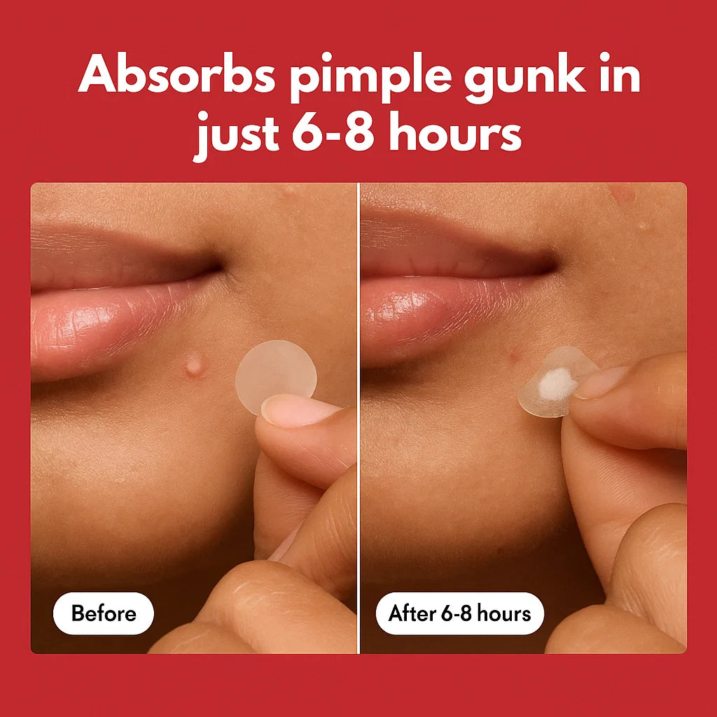 Invisible Acne Patch by Eelhoe
